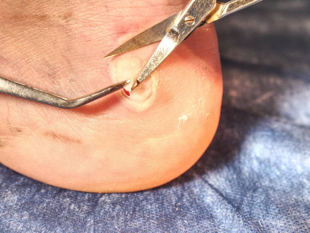 Tratamento médico da pele morta e abrasões molhadas no calcanhar. Consequências do calçado inadequado
. - Foto, Imagem