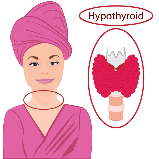Goiter. Enlarged Thyroid. Endocrine dysfunction vector illustration on a white background - Vector, Image