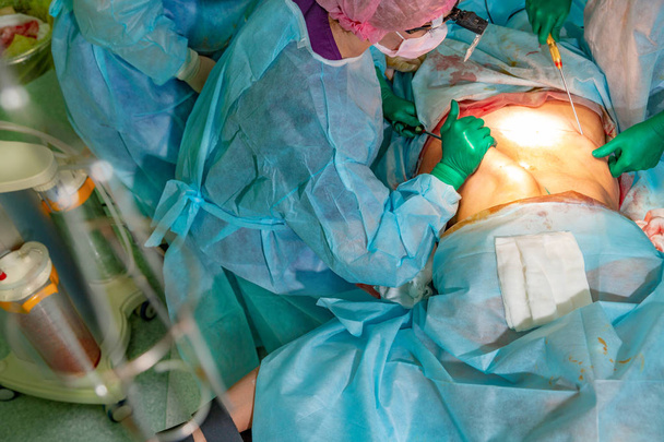 kosmetické liposukce ve skutečné operační sál, skupina lékařů pracují s kanylou - Fotografie, Obrázek