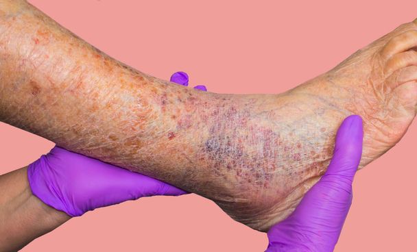 Gros plan de la peau avec des varices sur la jambe masculine aînée. Concept de peau sèche, personnes âgées, varices - Photo, image