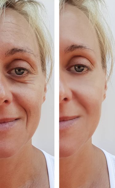 arrugas de la mujer en la cara antes y después de procedimientos antienvejecimiento
 - Foto, Imagen