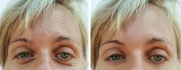rugas da mulher no rosto antes e depois de procedimentos anti-envelhecimento
 - Foto, Imagem