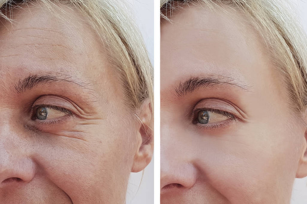 женщина морщит на лице до и после антивозрастных процедур
 - Фото, изображение