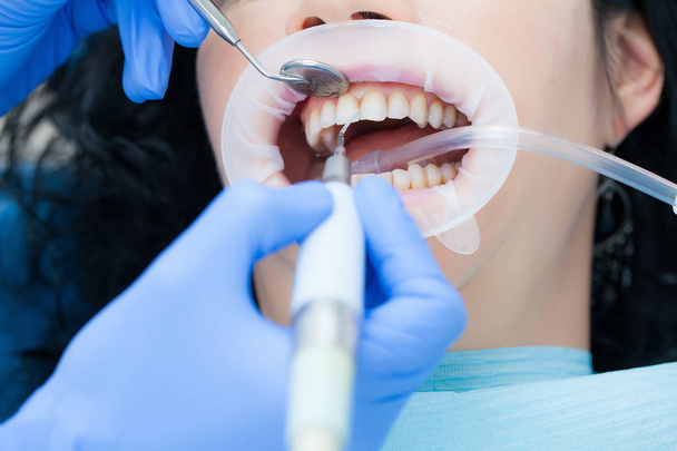Žena v dentální hygienické a zubní klinika profesionální bělení zubů a čištění ultrazvukem. Odontics a zdraví ústní dutiny. - Fotografie, Obrázek