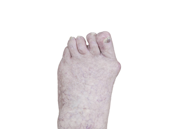 üst düzey bir kişinin ayak artrit, hasarlı çivi ve atlet ayağı üzerinde beyaz izole closeup - Fotoğraf, Görsel