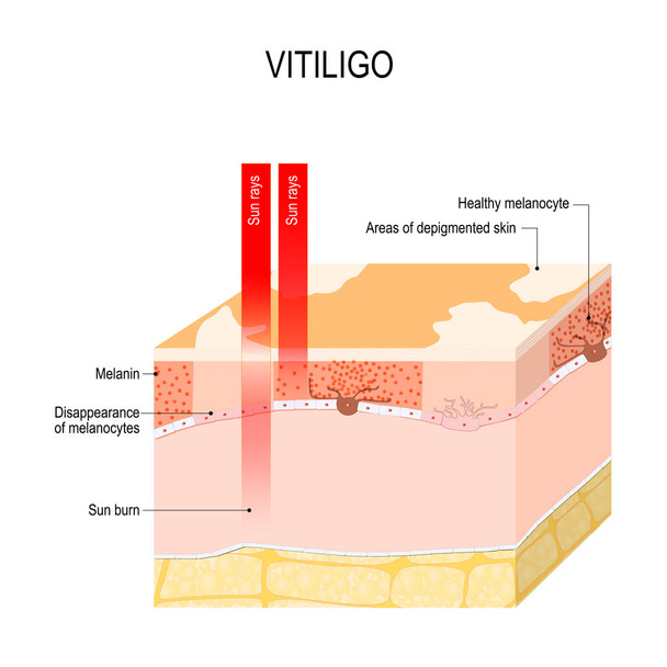 Vitiligo. On ihosairaus ominaista osia ihon menettävät pigmentti. Se tapahtuu, kun ihon pigmenttisolut (melanosyytit) kuolevat tai eivät pysty toimimaan. Vektorikaavio kasvatukselliseen, lääketieteelliseen, biologiseen ja tieteelliseen käyttöön
 - Vektori, kuva