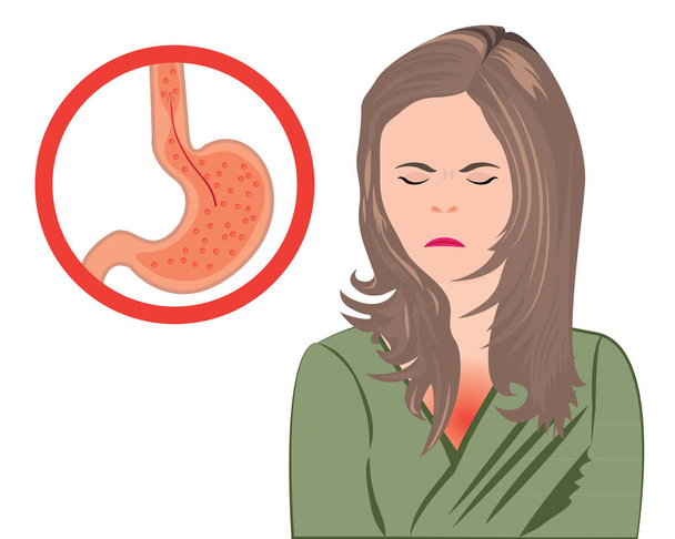 Gastrooesophagealis reflux betegség. Gerd gyomor emberi test vektor illusztráció - Vektor, kép