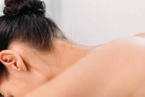 vista parcial de la mujer que tiene terapia de acupuntura en el salón de spa
 - Foto, imagen