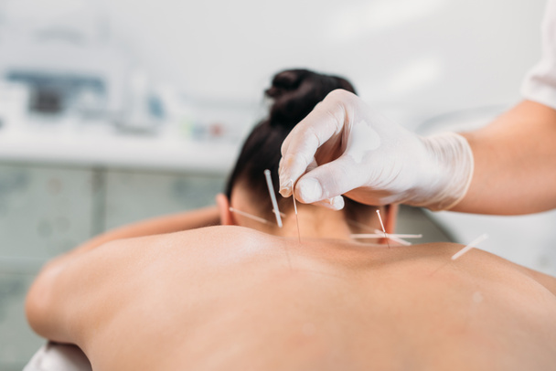 colpo ritagliato di cosmetologo mettendo aghi sulle donne indietro durante la terapia di agopuntura nel salone spa
 - Foto, immagini