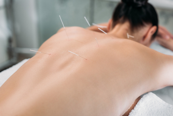 partial view of woman with needles on back having acupuncture therapy in spa salon - Foto, afbeelding