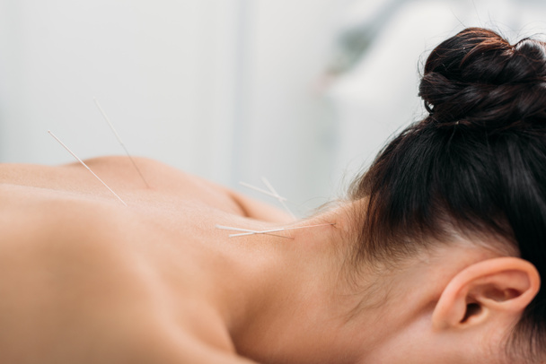 vista parcial de la mujer con agujas en el cuerpo que tiene terapia de acupuntura en el salón de spa
 - Foto, imagen