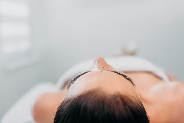 nő a tűk nagy homlok rendelkező akupunktúrás kezelés spa szalon - Fotó, kép
