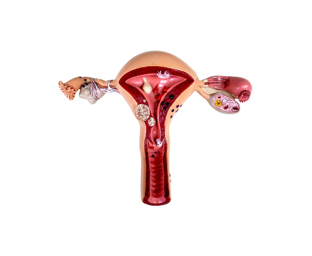 Patolojik kadın rahim ve yumurtalık tıbbi anatomi modeli. kırpma yolu - Fotoğraf, Görsel