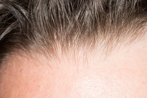 Τα μαλλιά στο κεφάλι του ένα άνθρωπος λεπτό εύθραυστα prollysiny σπάνιο για ιατρική σχεδιαστικό υπόβαθρο πίσω - Φωτογραφία, εικόνα