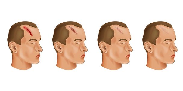 vector illustration of a cut head wound - Vector, Image