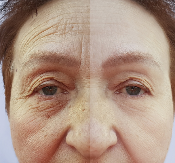rosto de uma mulher idosa rugas antes e depois de procedimentos
 - Foto, Imagem