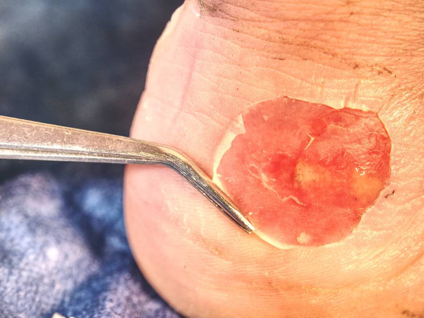 Blister van verkeerde laarzen en infectie wond in de huid van de voet van patiënten.  - Foto, afbeelding