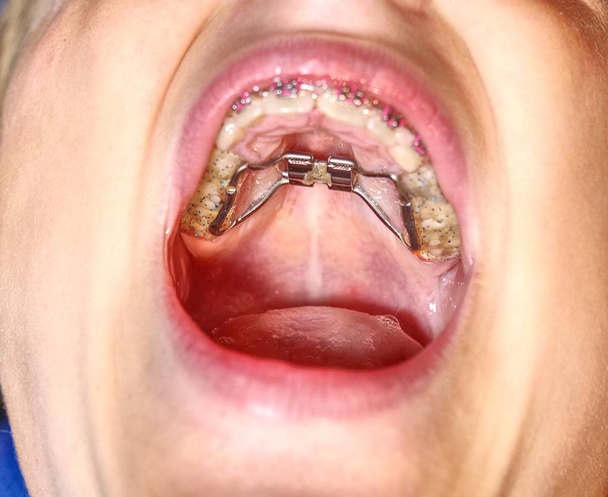Tirantes rápidos de expansión palatina Hyrax para corrección de mandíbula delgada. El niño muestra los frenos del marco dental
.  - Foto, imagen