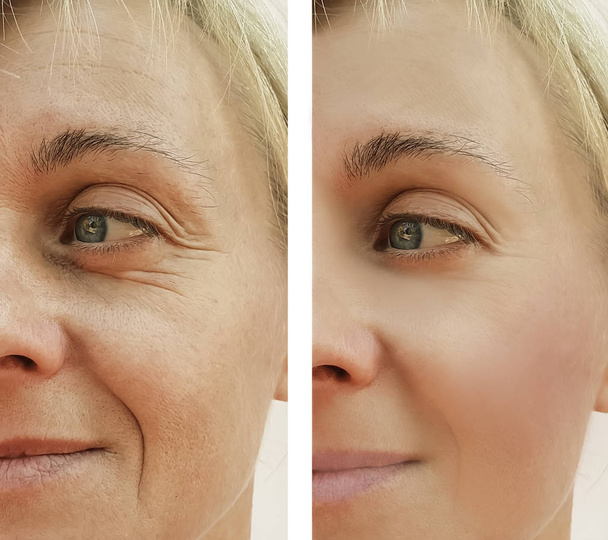 žena vrásky tvář před a po kosmetických procedur - Fotografie, Obrázek