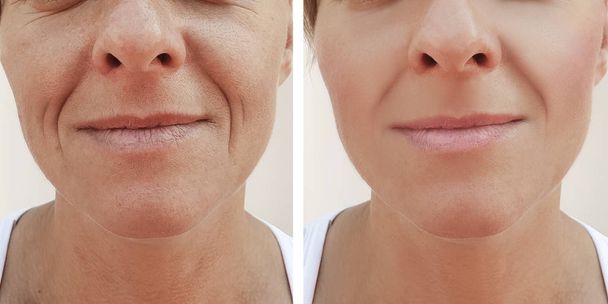 γυναίκα, πρόσωπο ρυτίδες πριν και μετά από αισθητικές επεμβάσεις - Φωτογραφία, εικόνα