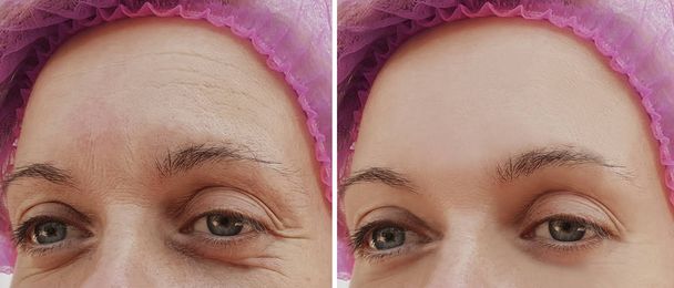 γυναίκα, πρόσωπο ρυτίδες πριν και μετά από αισθητικές επεμβάσεις - Φωτογραφία, εικόνα