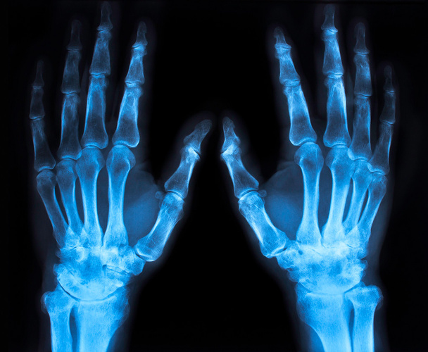 Röntgenbild einer Hand (blau)) - Foto, Bild