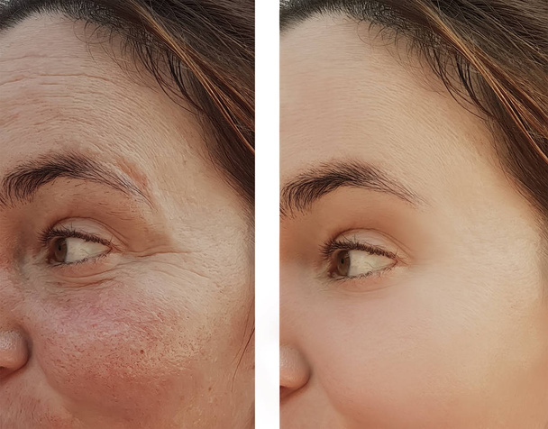 Falten im Gesicht einer Augenärztin vor und nach kosmetischen Eingriffen - Foto, Bild