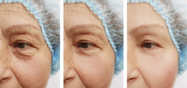  elderly woman wrinkles on face before after procedures - Photo, Image