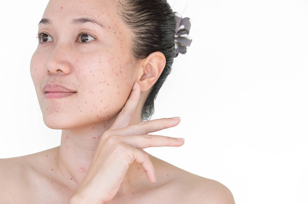 レーザー治療にきび肌、アジアの女性の首や顔に黒い斑点、そばかすそばかすの斑点やかさぶたを書き込む. - 写真・画像