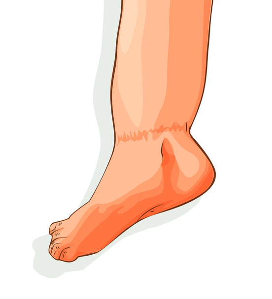 Ilustración vectorial de edema en los pies. Hinchazón de los pies y tobillos
. - Vector, imagen