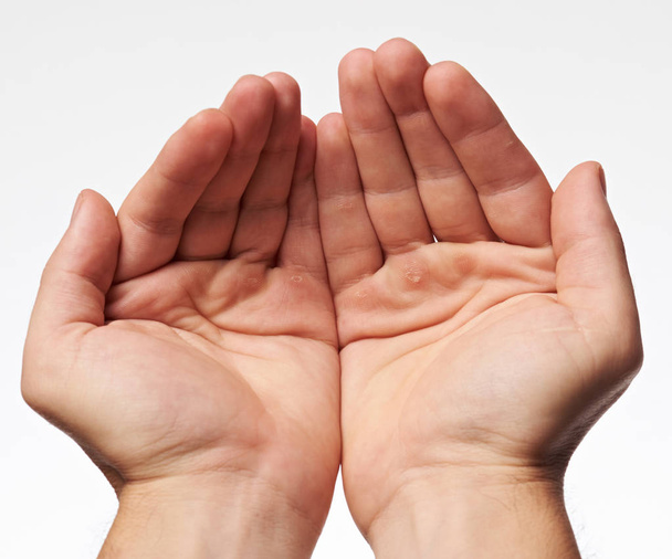 Две руки ладонь с волдырем
 - Фото, изображение