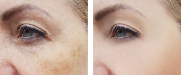 nainen kasvot ryppyjä pigmentaatio ennen ja jälkeen menettelyjen
 - Valokuva, kuva