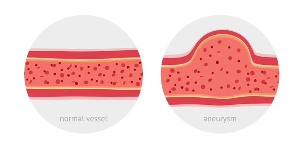 Statku zdrowe i chore naczynie z tętniaka z ilustracji wektorowych płaskie komórki krwi - Wektor, obraz