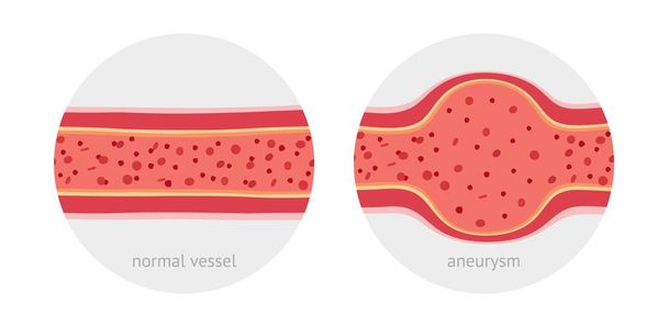 Gezonde en zieke met aneurysma met bloedcellen platte vectorillustratie - Vector, afbeelding