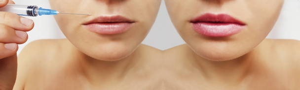 lábios de menina, injeção de seringa, aumento antes e depois de procedimentos
 - Foto, Imagem