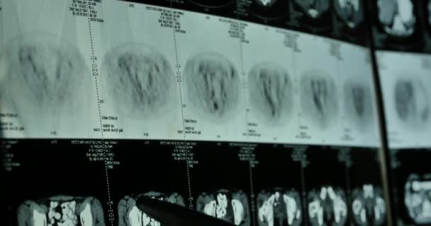 Artsen onderzoeken hoofd schedel hersenen X-ray film voor analysis.health medisch ziekenhuis. - Video