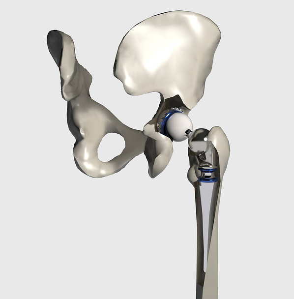 Installation einer Hüftprothese mit Femur, 3D-Rendering - Foto, Bild