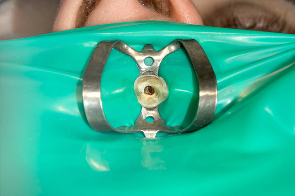 primer plano tratado diente humano en un relleno dental podrido clinic.Ochistka y canales con el uso de sistema de sello de presa de goma y puesta en escena
 - Foto, imagen