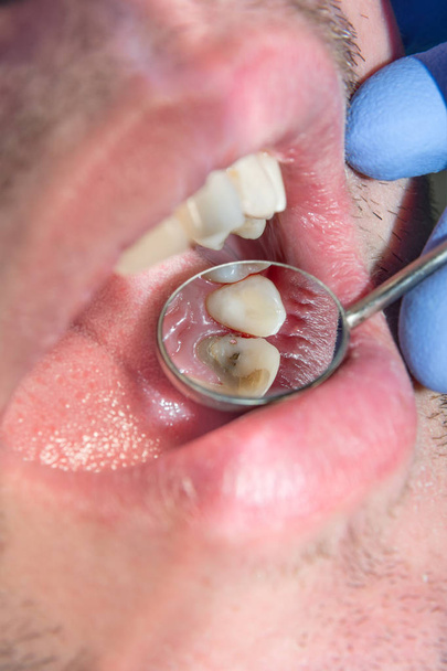 Foto endodontische behandeling van tandheelkundige grachten in de lagere molaire permanente tand molaire met endodontische bestand met apex locator, tand met klem die eraan verbonden zijn door cofferdam - Foto, afbeelding