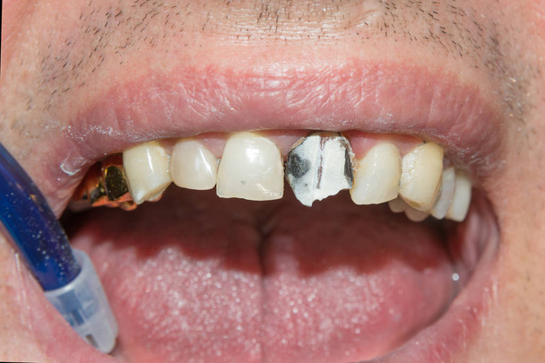 Diş kökleri tedavisinde. Mühürleme ve makro carious insan dişi close-up Temizleme. Yenilik ve teknoloji modern endodontik tedavi hastaların kavramı - Fotoğraf, Görsel