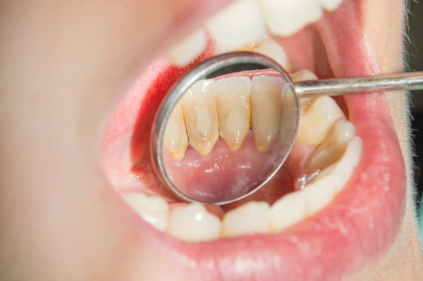 Крупный план макро-стоматологического анализа и зубной бляшки. Гигиена полости рта в стоматологии
 - Фото, изображение