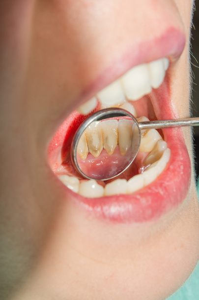 hammaskiven lähikuva alemmissa etuhampaissa. Hampaiden hygienia
 - Valokuva, kuva