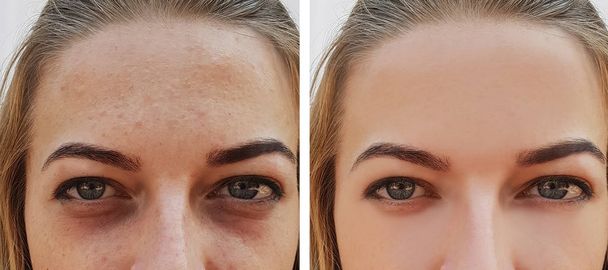 ojo chica bolsa bajo los ojos antes y después
 - Foto, Imagen