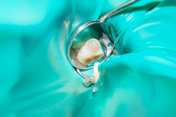 крупным планом гнилого кариозного зуба человека на стадии лечения в стоматологической клинике. Использование системы резиновых плотин с латексными шарфами и металлическими зажимами, производство фотополимерных композитных пломб
 - Фото, изображение