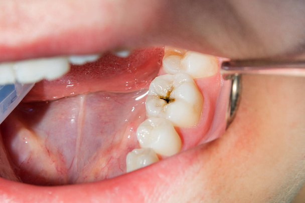 közeli kép: egy rohadt szuvas fog a kezelési szakaszban egy fogászati klinika. Gumi gát rendszer a latex sálak és fém csipeszek, photopolymeric kompozit tömések gyártása - Fotó, kép