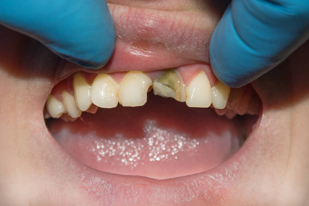 Close-up van een menselijke rotte carieus tand in het stadium van de behandeling in een tandheelkundige kliniek. Het gebruik van een rubber dam systeem met latex sjaals en metalen clips, productie van photopolymeric composiet vullingen - Foto, afbeelding