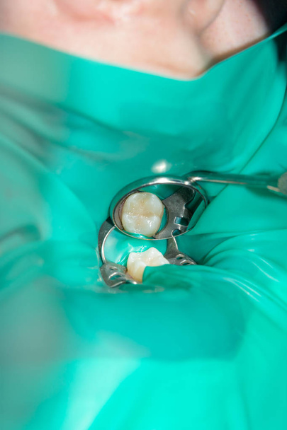 bir insan çürük carious diş tedavi aşamasında bir diş kliniğinde yakın çekim. Kauçuk baraj sistemiyle lateks eşarp ve metal klipleri, photopolymeric kompozit dolgular üretiminde kullanımı - Fotoğraf, Görsel