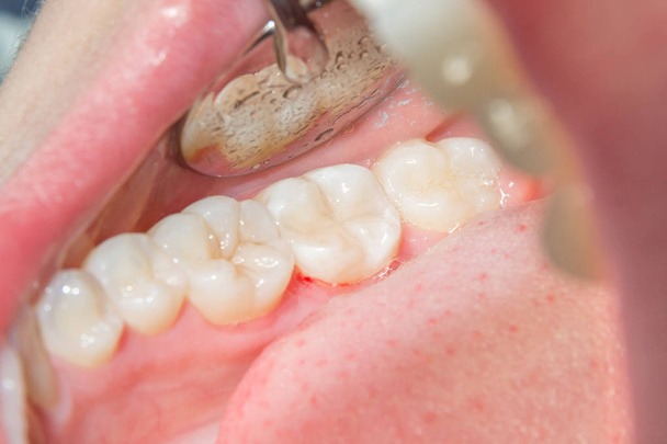 gros plan d'une dent carieuse pourrie humaine au stade du traitement dans une clinique dentaire. L'utilisation du système de barrage en caoutchouc avec écharpes en latex et clips métalliques, la production de garnitures composites photopolymériques
 - Photo, image