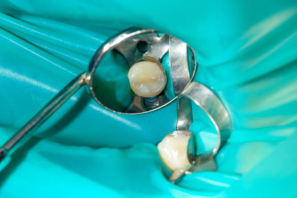 歯科医院で治療の段階で腐った人間の齲蝕歯のクローズ アップ。ラテックスのスカーフと金属製のクリップのゴム ダム システム photopolymeric コンポジット充填材料の生産の使用 - 写真・画像