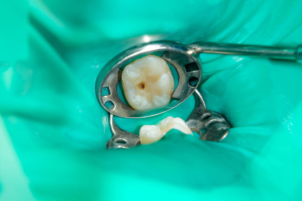 close-up of a human rotten carious tooth at the treatment stage in a dental clinic. The use of rubber dam system with latex scarves and metal clips, production of photopolymeric composite fillings - Photo, Image